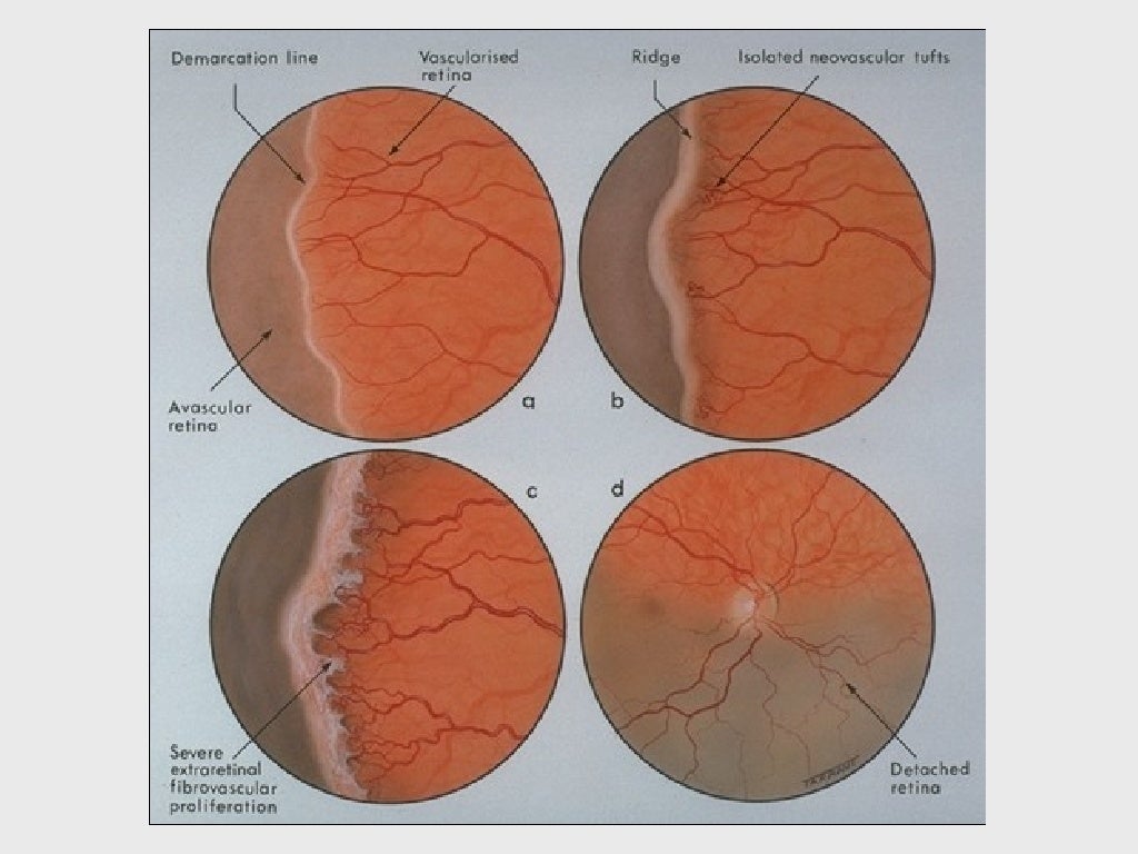 VASCULAR AND HEREDITARY RETINAL DISEASE