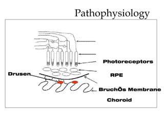 Pathophysiology Drusen Bruch’s Membrane RPE Photoreceptors Choroid 