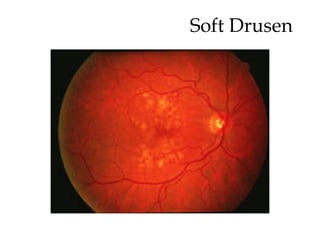 Soft Drusen 