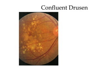 Confluent Drusen 