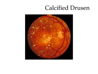 Calcified Drusen 