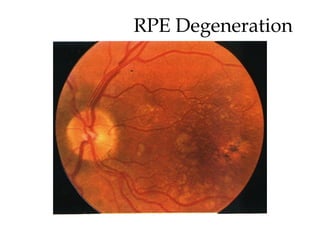RPE Degeneration 