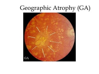 Geographic Atrophy (GA) 