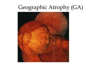 Geographic Atrophy (GA) 