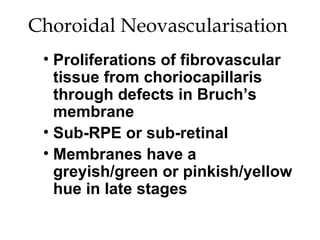 Choroidal Neovascularisation  Proliferations of fibrovascular tissue from choriocapillaris through defects in Bruch’s membrane Sub-RPE or sub-retinal Membranes have a greyish/green or pinkish/yellow hue in late stages 