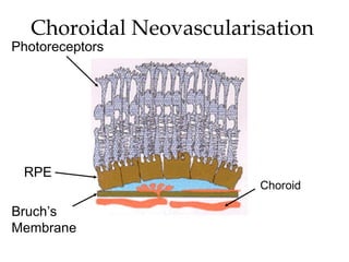 Choroidal Neovascularisation  RPE Bruch’s  Membrane Photoreceptors Choroid 
