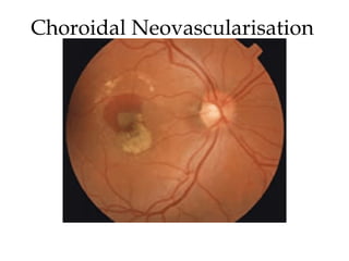 Choroidal Neovascularisation  