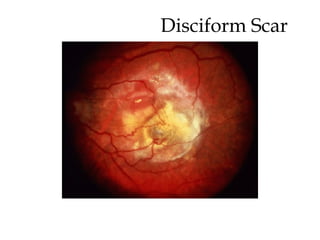 Disciform Scar  