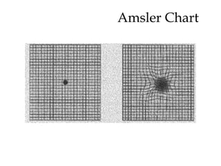 Amsler Chart  