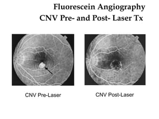 Fluorescein Angiography CNV Pre- and Post- Laser Tx   CNV Pre-Laser CNV Post-Laser 