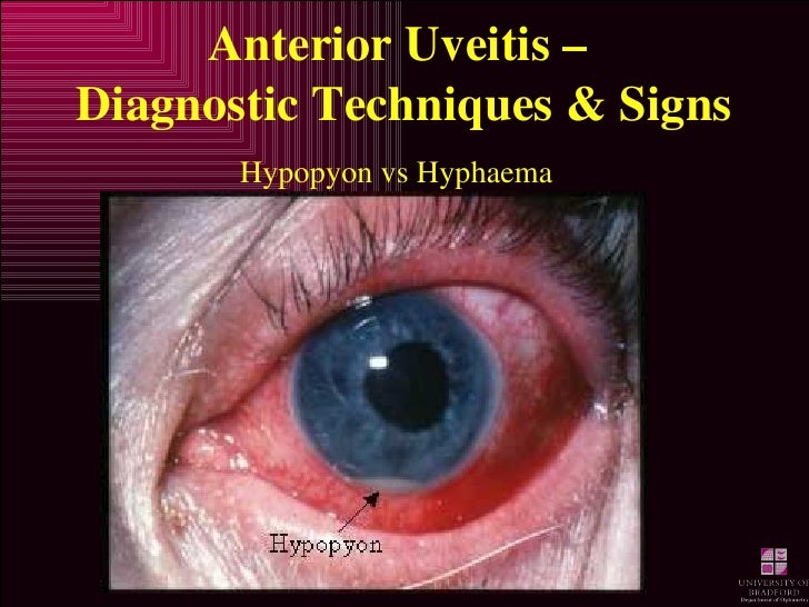 anterior uveitis posterior uveitis