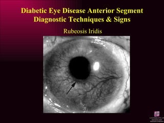 Diabetic Eye Disease | PPT
