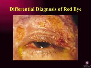Differential Diagnosis of Red Eye 