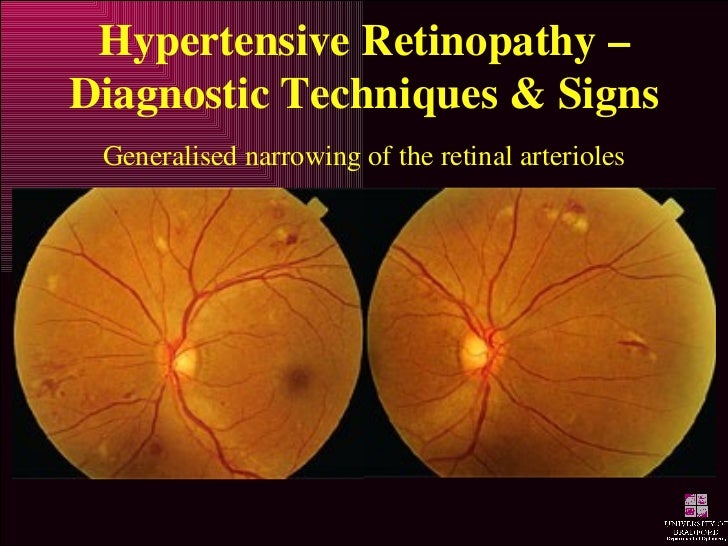 Hypertensive Retinopathy