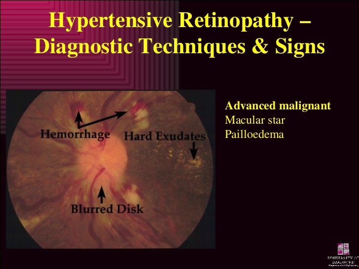 Hypertensive Retinopathy