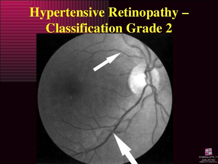 hypertensive retinopathy
