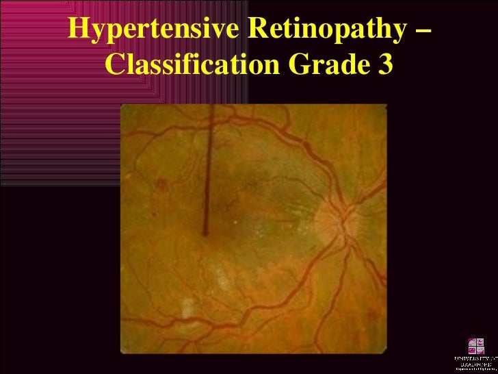 hypertensive retinopathy