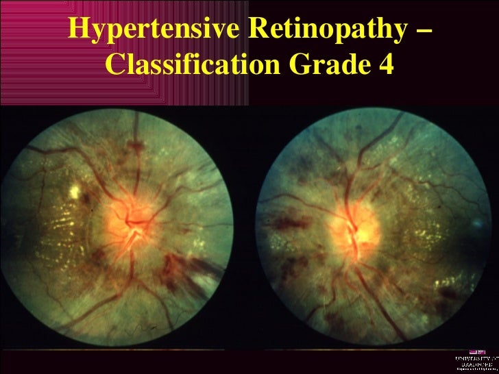 hypertensive retinopathy