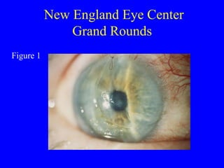 New England Eye Center Grand Rounds  Figure 1 