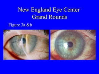 New England Eye Center  Grand Rounds Figure 3a &b 