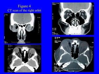 Figure 4 CT scan of the right orbit 