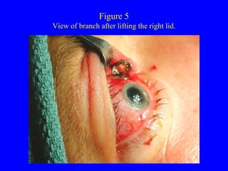 Figure 5 View of branch after lifting the right lid. 