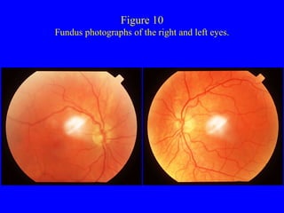 Figure 10 Fundus photographs of the right and left eyes. 