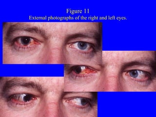 Figure 11 External photographs of the right and left eyes. 