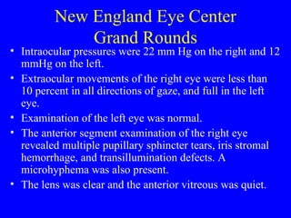 New England Eye Center Grand Rounds Intraocular pressures were 22 mm Hg on the right and 12 mmHg on the left. Extraocular movements of the right eye were less than 10 percent in all directions of gaze, and full in the left eye. Examination of the left eye was normal. The anterior segment examination of the right eye revealed multiple pupillary sphincter tears, iris stromal hemorrhage, and transillumination defects. A microhyphema was also present.  The lens was clear and the anterior vitreous was quiet. 