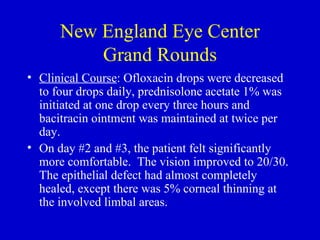 New England Eye Center Grand Rounds Clinical Course : Ofloxacin drops were decreased to four drops daily, prednisolone acetate 1% was initiated at one drop every three hours and bacitracin ointment was maintained at twice per day. On day #2 and #3, the patient felt significantly more comfortable.  The vision improved to 20/30. The epithelial defect had almost completely healed, except there was 5% corneal thinning at the involved limbal areas. 