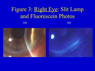 Figure 3:  Right Eye : Slit Lamp and Fluorescein Photos OD   OD 