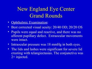 New England Eye Center Grand Rounds Ophthalmic Examination :  Best corrected visual acuity: 20/40 OD; 20/20 OS Pupils were equal and reactive, and there was no afferent pupillary defect.  Extraocular movements were intact.  Intraocular pressure was 18 mmHg in both eyes. The lids and lashes were significant for severe lid crusting with telangiectasias. The conjunctiva was 2+ injected. 