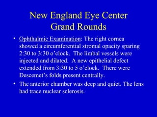 New England Eye Center Grand Rounds Ophthalmic Examination : The right cornea showed a circumferential stromal opacity sparing 2:30 to 3:30 o’clock.  The limbal vessels were injected and dilated.  A new epithelial defect extended from 3:30 to 5 o’clock.  There were Descemet’s folds present centrally.  The anterior chamber was deep and quiet. The lens had trace nuclear sclerosis.  