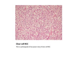 Renal Cell Carcinoma GrossMicroPath.pptx