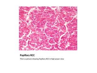 Papillary Rcc Radiopaedia Renal Cell Carcinoma GrossMicroPath.pptx