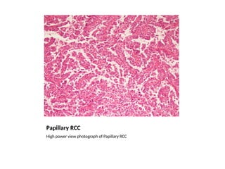 Papillary Rcc Radiopaedia Renal Cell Carcinoma GrossMicroPath.pptx