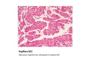 Renal Cell Carcinoma GrossMicroPath.pptx