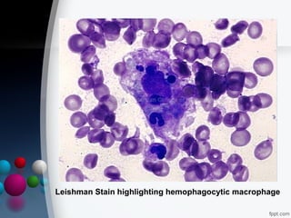 Leishman Stain highlighting hemophagocytic macrophage

 