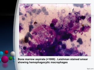 Bone marrow aspirate (×1000) . Leishman stained smear
showing hemophagocytic macrophages

 