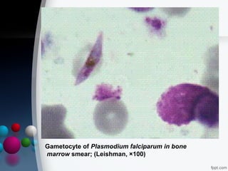 Gametocyte of Plasmodium falciparum in bone
marrow smear; (Leishman, ×100)

 