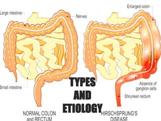 TYPES
AND
ETIOLOGY
 