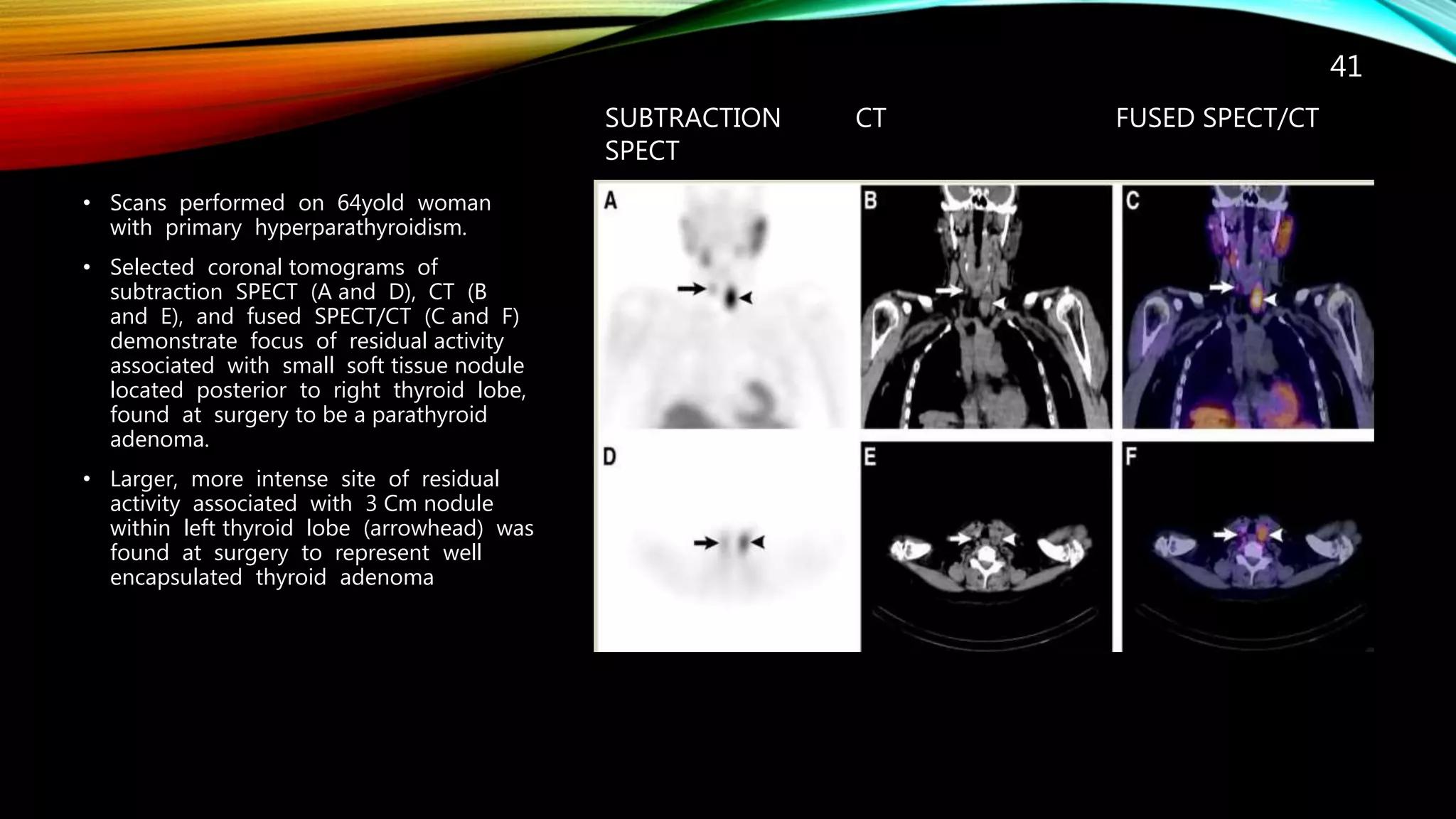 IMAGING IN HYPERPARATHYROIDISM | PPTX