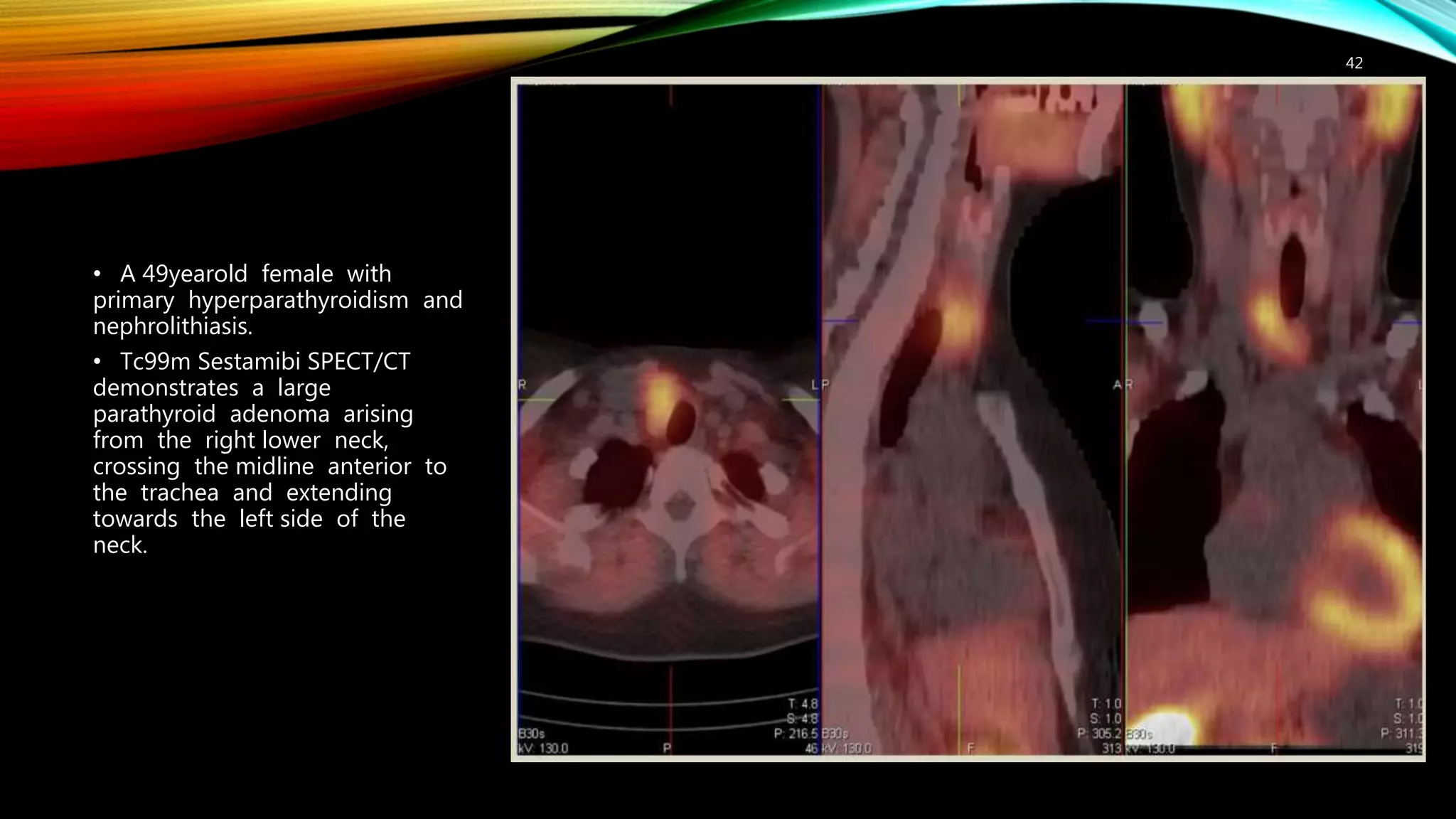 IMAGING IN HYPERPARATHYROIDISM | PPTX