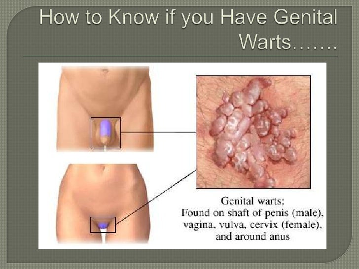 Early Signs of Genital Warts | DrEd