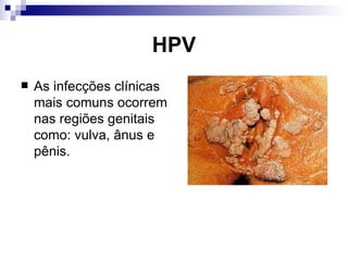 HPV As infecções clínicas mais comuns ocorrem nas regiões genitais como: vulva, ânus e pênis. 