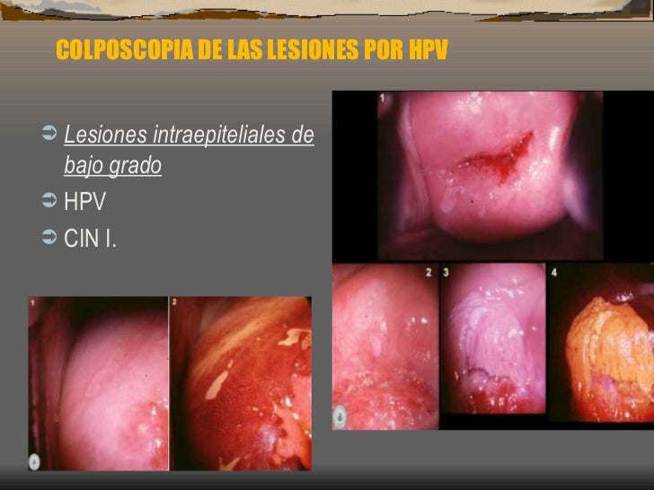 Fotos papiloma humano verrugas genitales 94 Fotos papiloma humano verrugas genitales 52