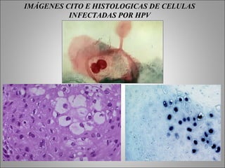 IMÁGENES CITO E HISTOLOGICAS DE CELULAS
          INFECTADAS POR HPV
 