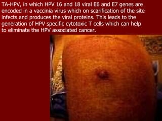 TA-HPV, in which HPV 16 and 18 viral E6 and E7 genes are encoded in a vaccinia virus which on scarification of the site infects and produces the viral proteins. This leads to the generation of HPV specific cytotoxic T cells which can help to eliminate the HPV associated cancer.  