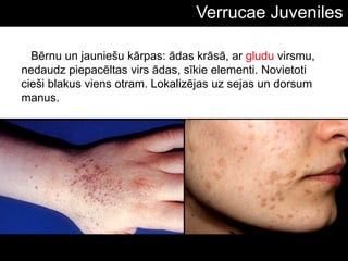 Verrucae Juveniles
Bērnu un jauniešu kārpas: ādas krāsā, ar gludu virsmu,
nedaudz piepacēltas virs ādas, sīkie elementi. Novietoti
cieši blakus viens otram. Lokalizējas uz sejas un dorsum
manus.
 
