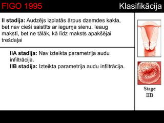 II stadija: Audzējs izplatās ārpus dzemdes kakla,
bet nav cieši saistīts ar iegurņa sienu. Ieaug
makstī, bet ne tālāk, kā līdz maksts apakšējai
trešdaļai
IIA stadija: Nav izteikta parametrija audu
infiltrācija.
IIB stadija: Izteikta parametrija audu infiltrācija.
KlasifikācijaFIGO 1995
 